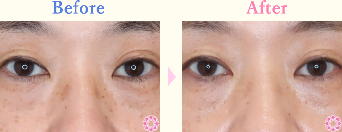 シミ・肝斑・美白｜症例写真｜美容整形のことなら東京形成美容外科