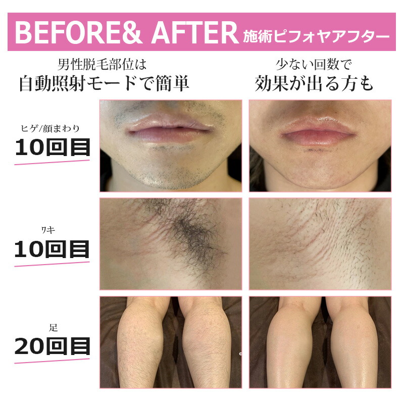 楽天市場】【見逃すな爆安セール限定価格19,800円】脱毛器 脱毛機