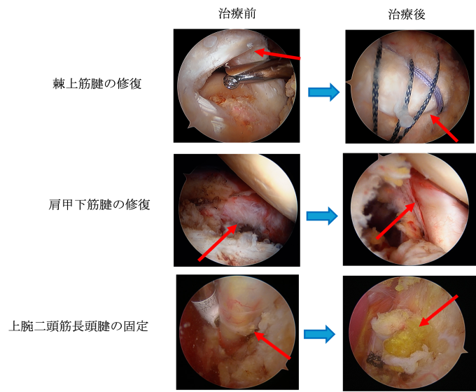 肩関節診療 ｜ 札幌医科大学医学部 整形外科学講座