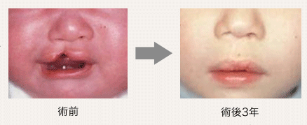 札幌医科大学 形成外科｜口唇裂・口蓋裂の治療｜口唇裂の治療