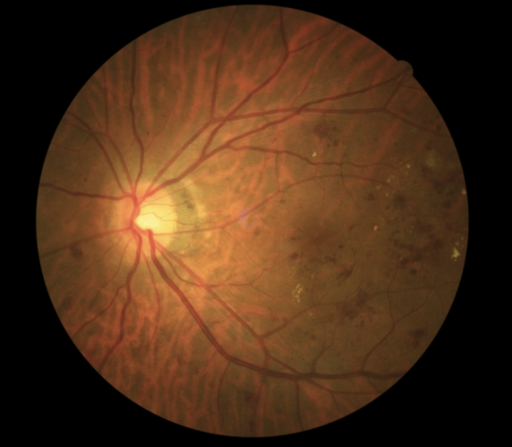 糖尿病網膜症は治るの?眼科医が早期発見と治療法を解説 | コラム