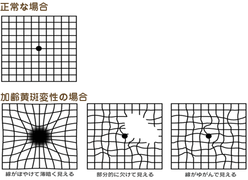 加齢黄斑変性 | 世田谷区 梅ヶ丘ひかり眼科