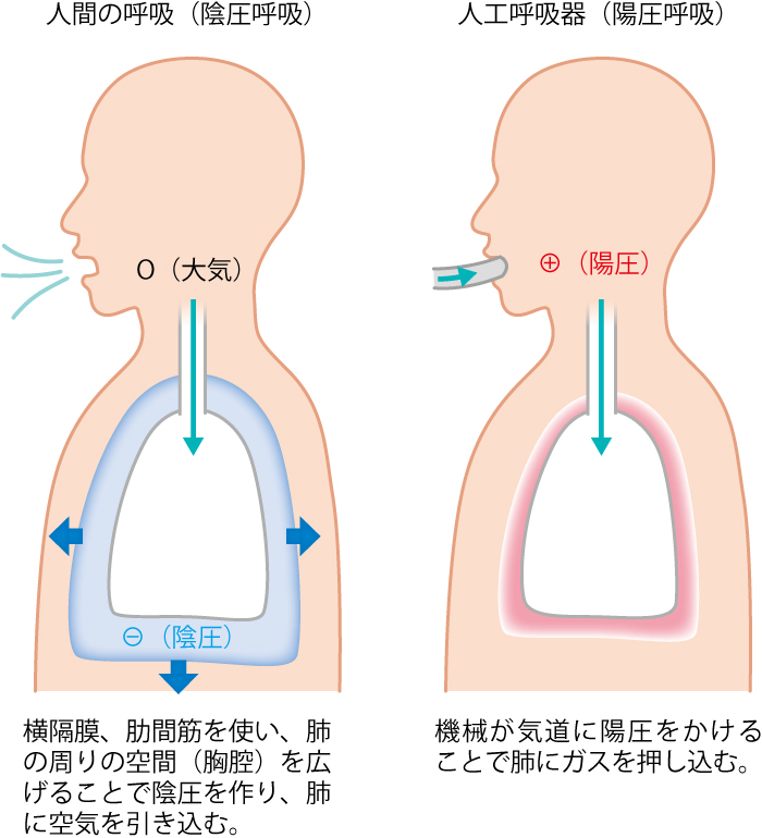 人工呼吸器管理と人工呼吸器関連肺炎の基礎知識 | アイ・エム・アイ