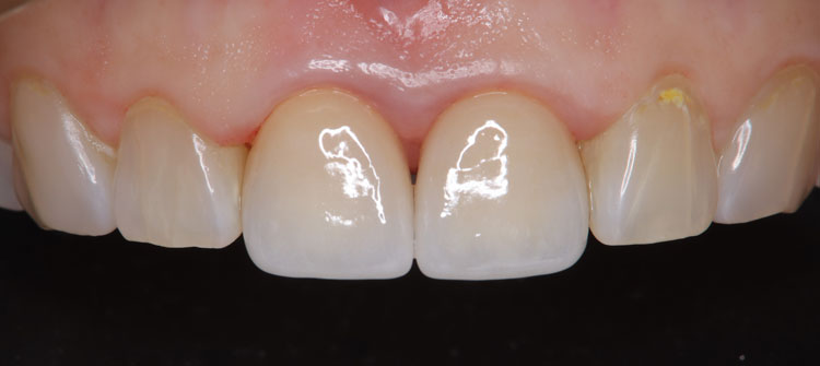 他院でのやり直しを行った前歯2本の審美歯科治療（セラミッククラウン