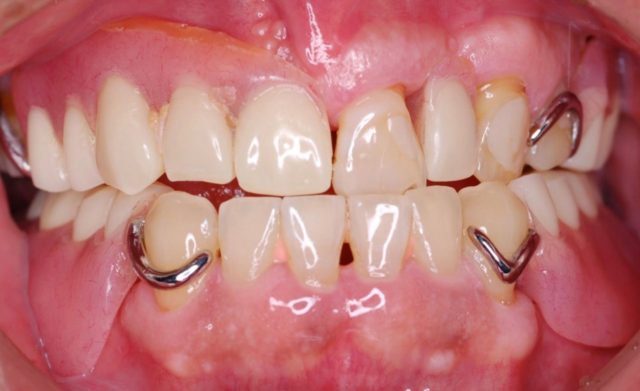 多数歯のインプラント治療（多数歯欠損の咬合再構成症例）その①