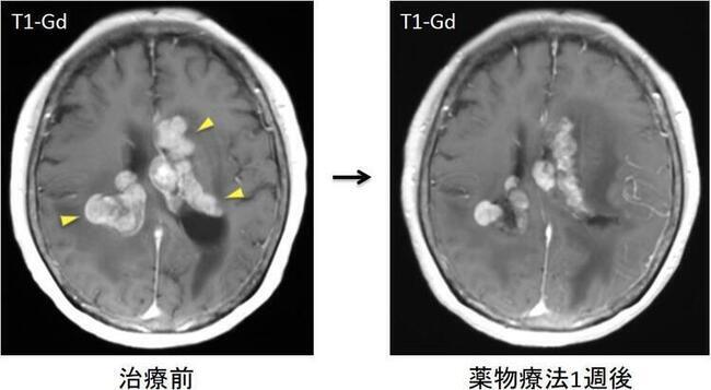 認知症の原因となる脳腫瘍 ｜ 国立長寿医療研究センター