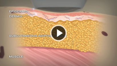 ライポソニックス（Liposonix）| ボディ・医療痩身｜北九州の美容外科