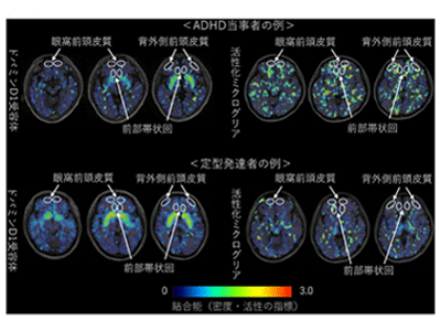 ADHDの重症度に、ドパミンD1受容体と活性化ミクログリアが関与－浜松
