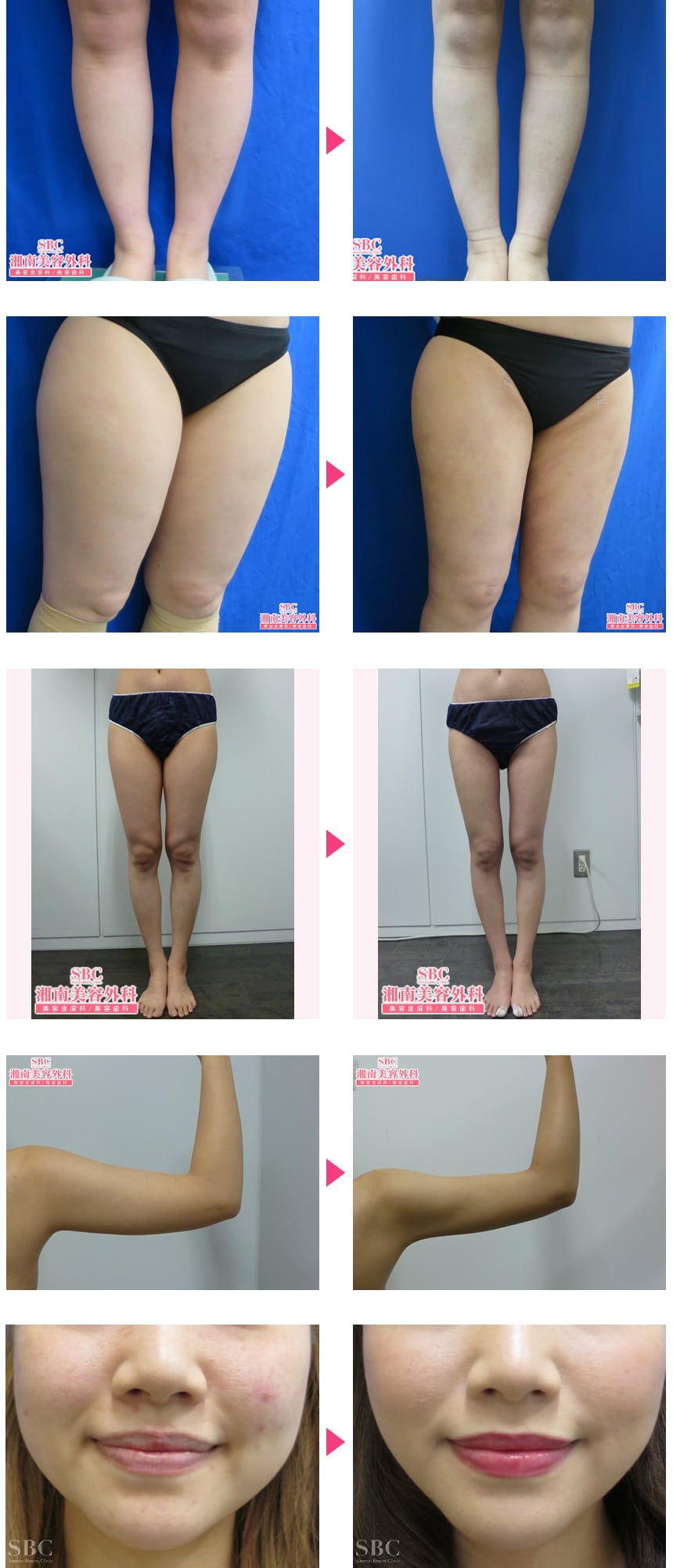 美ボディ脂肪吸引お手頃価格 腕・肩】 …｜脂肪吸引モニター募集｜美容