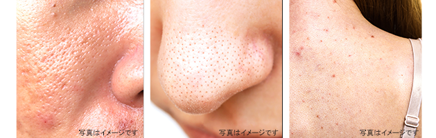 ハイドラフェイシャル（Hydra Facial） | 診療 | S-medic 美