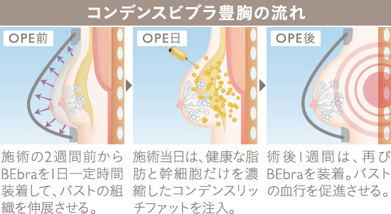 コンデンスビブラ豊胸｜THE CLINIC （ザクリニック）【公式】