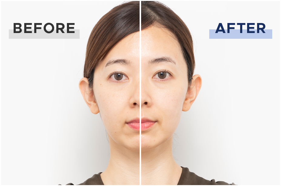 ハイパーフェイスリフトブラシ｜進化したリフトケア｜ヤーマン