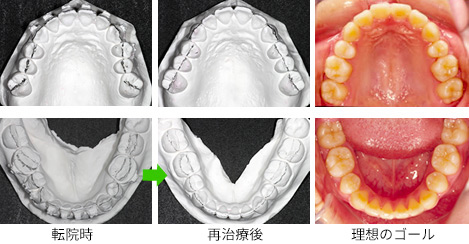 失敗矯正例5】途中なのに治療終了の宣告 - Yogosawa Foundation