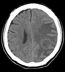 脳膿瘍 | 福岡の脳神経外科 - はしぐち脳神経クリニック