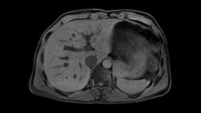 Philips - 3D VANE XD MRクリニカルアプリケーション