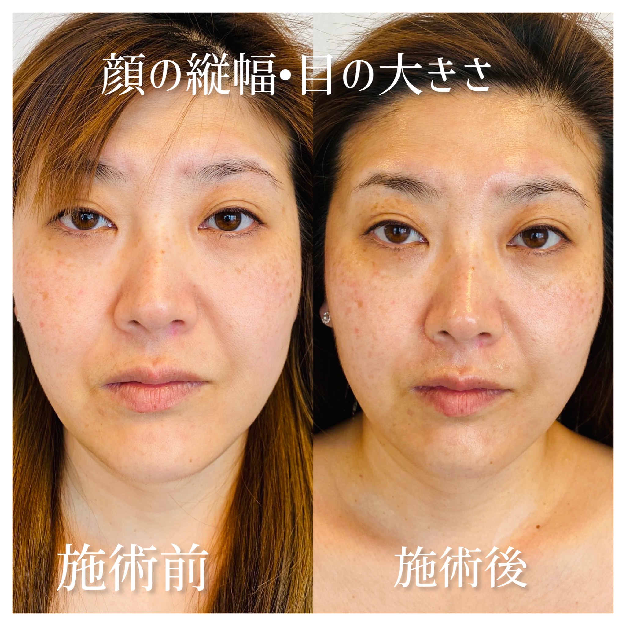 最先端プラズマシャワーPLASMA REVO.V（プラズマレボV)｜有限会社