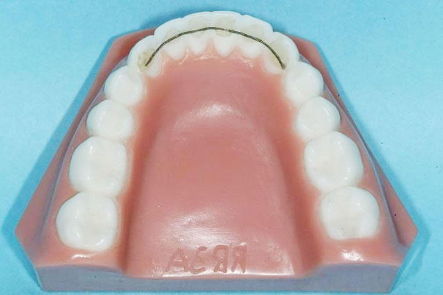 保定装置｜豊中市の矯正歯科｜千里中央駅前のジョイスマイル矯正歯科