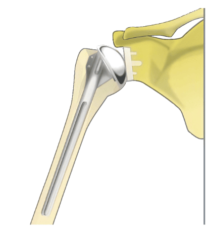 変形性肩関節症の人工肩関節全置換術、リバース型人工肩関節全置換術