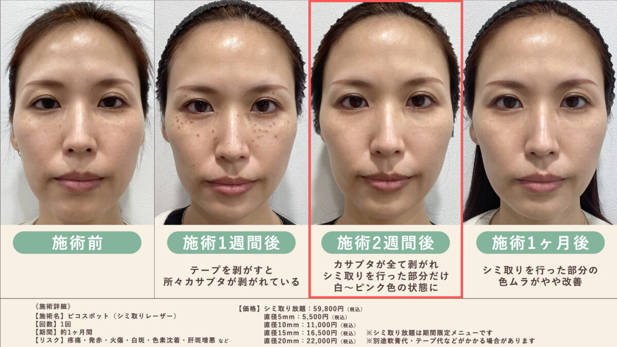 シミ取りレーザー後の経過とケア手順について｜恵比寿アズクリニック