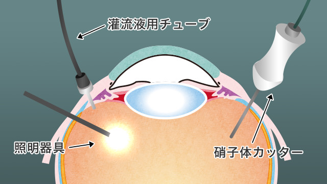 硝子体手術・日帰り手術 | 兵庫県明石市の田村眼科｜JR明石駅徒歩2分